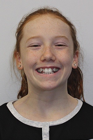 Teen with misaligned teeth before orthodontics
