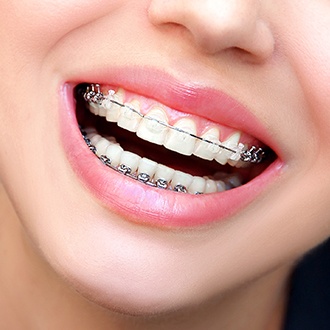 Closeup of smile with clear and ceramic braces