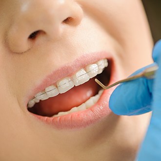 Closeup of smile with dentist placing clear and ceramic braces