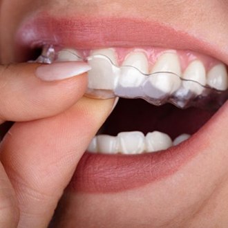 close up of person putting Invisalign aligner in their mouth 