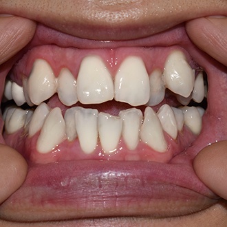 a close-up of a patient with crowded teeth 