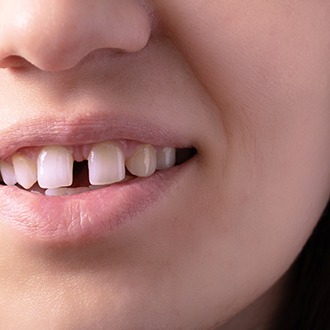 a patient with a gap between her front teeth