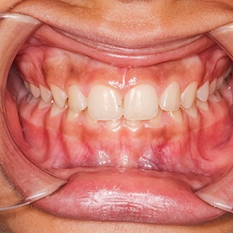 a close-up of a patient with an overbite