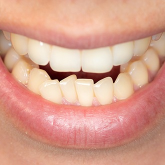 a close-up of a patient with an underbite