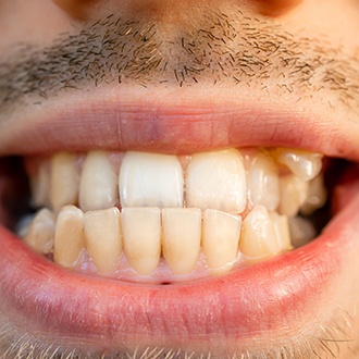 a close-up of a patient with a crossbite