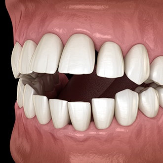 a 3D illustration of teeth with an open bite  