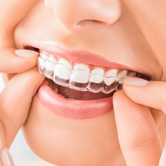 Closeup of patient placing Invisalign tray