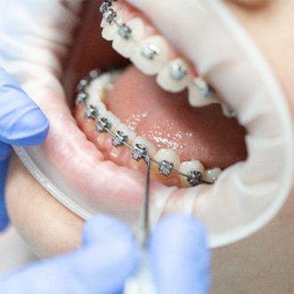 Closeup of Holliston orthodontist placing braces on patient's teeth