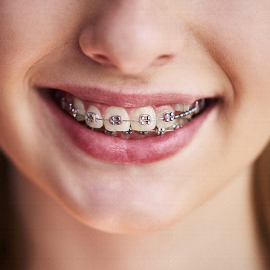 Closeup of patient with braces from Holliston orthodontist