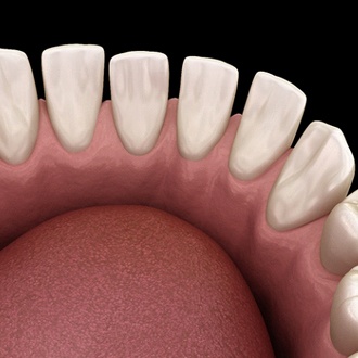 Diagram from Holliston orthodontist showing gapped teeth