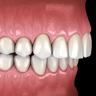 Diagram from Holliston orthodontist showing overbite in Holliston