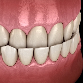 Diagram from Holliston orthodontist showing underbite in Holliston