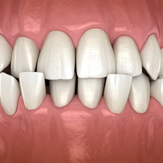 Diagram from Holliston orthodontist showing crossbite crooked teeth