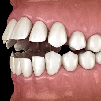 Diagram from Holliston orthodontist showing open bite problems