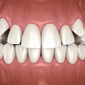 Diagram from Holliston orthodontist showing impacted canines in Holliston