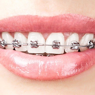 Closeup of smile with self ligtating braces