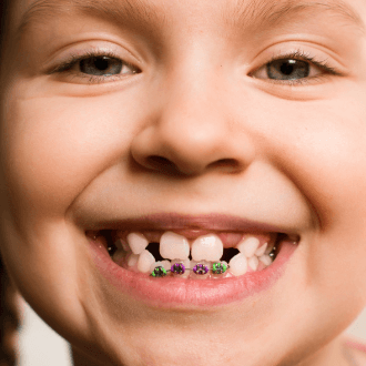 Closeup of child's smile with pediatric orthodontics in place