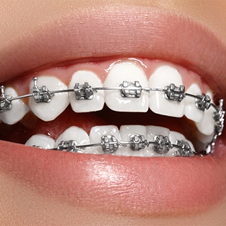 Closeup of smile with traditional braces