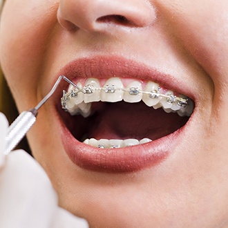 Closeup of smile during braces application