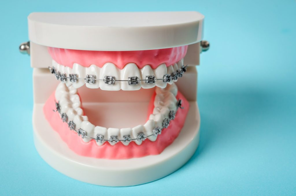 Model of teeth with metal braces