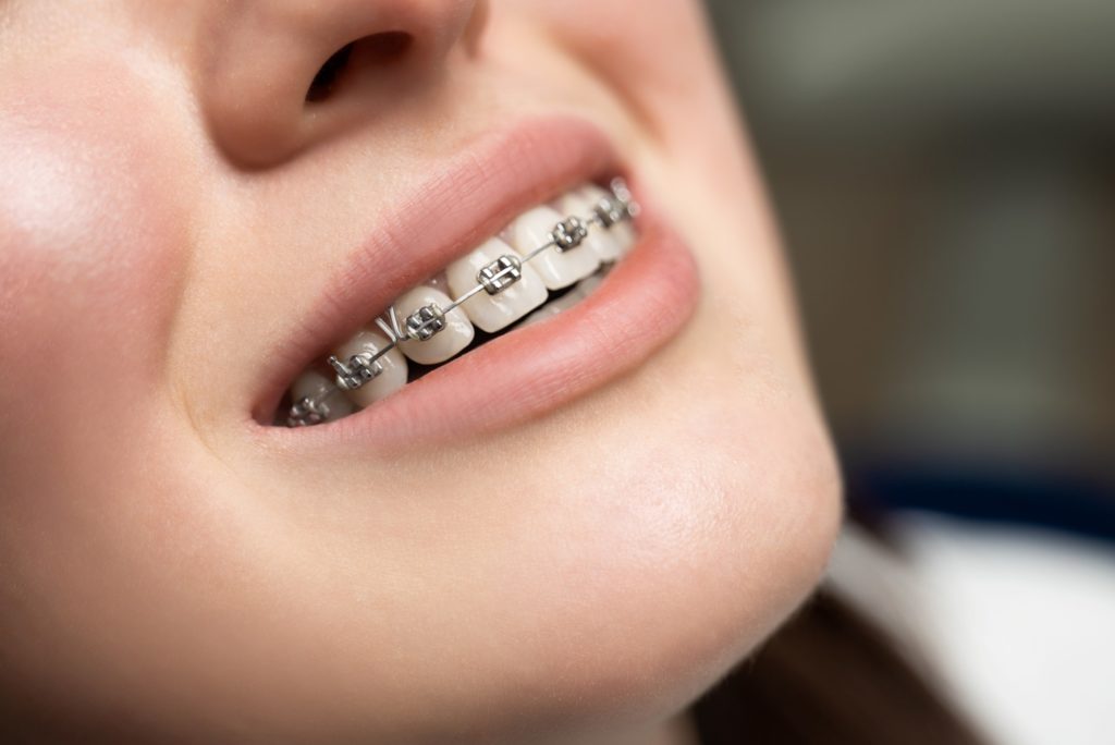Closeup of woman with metal braces smiling