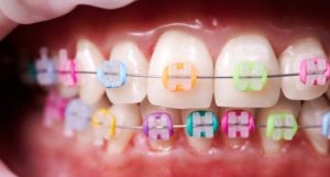 Close-up of rubber bands on braces 
