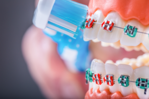 a closeup of a patient with braces brushing her teeth 